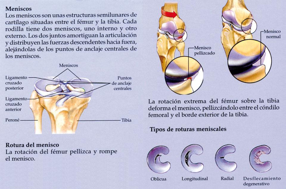 Menisco:  rotura del menisco de la rodilla