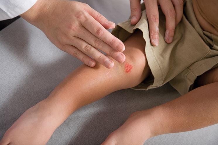 La rodilla infantil: lesiones más frecuentes